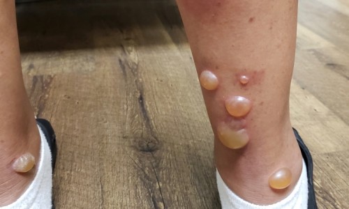 糖尿病病人能吃营养粉吗专区_全营养蛋白粉的功效与作用专区_全营养蛋白质粉糖尿病人能吃吗网